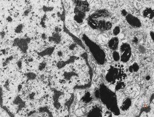 M,6m. | maxilla - melanotic progonoma (melanotic neuroectodermal tumor of infancy)